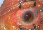 Хакасские офтальмологи чуть не лишили человека зрения